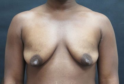 Mommy Makeover Before & After Patient #2607