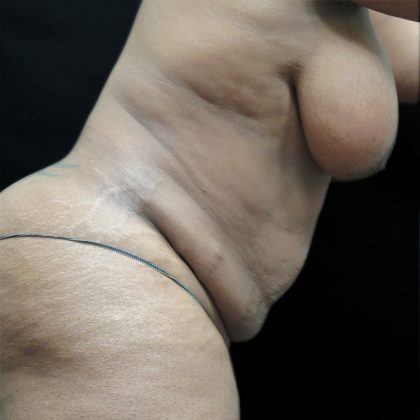Tummy Tuck Before & After Patient #3267