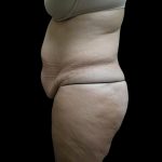 Tummy Tuck Before & After Patient #3286