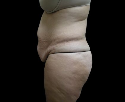 Tummy Tuck Before & After Patient #3286
