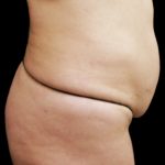 Tummy Tuck Before & After Patient #3293