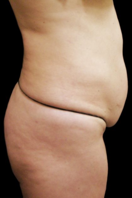 Tummy Tuck Before & After Patient #3293