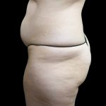 Tummy Tuck Before & After Patient #3312