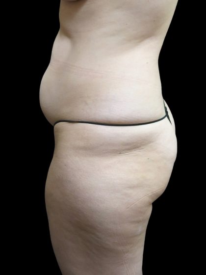 Tummy Tuck Before & After Patient #3312