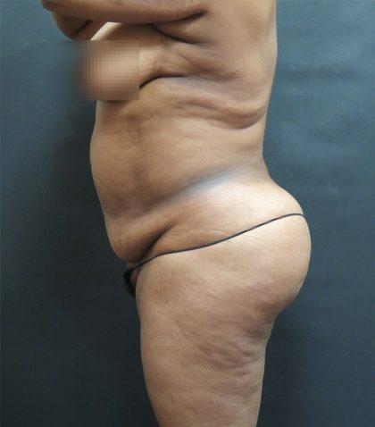 Tummy Tuck Before & After Patient #3333