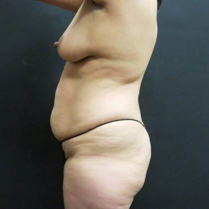 Tummy Tuck Before & After Patient #3340