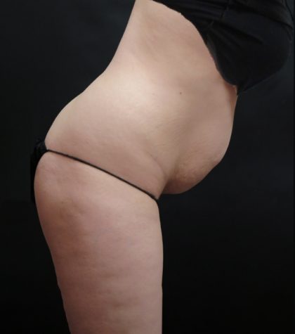 Mommy Makeover Before & After Patient #2644