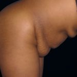 Tummy Tuck Before & After Patient #3366