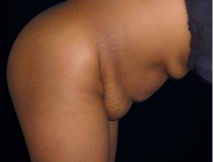 Tummy Tuck Before & After Patient #3366