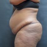 Tummy Tuck Before & After Patient #3380