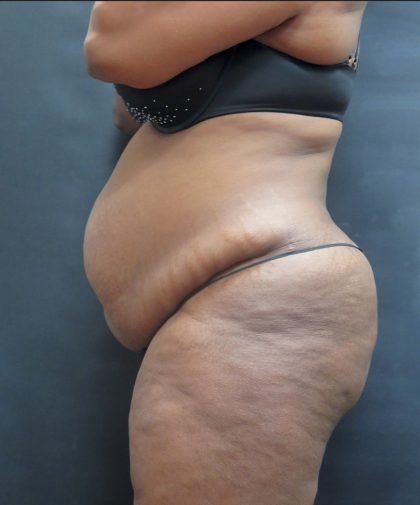 Tummy Tuck Before & After Patient #3380