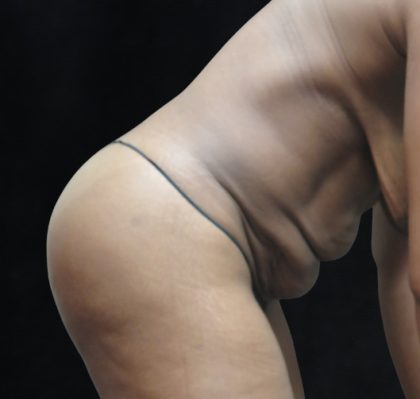 Tummy Tuck Before & After Patient #3387