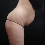 Tummy Tuck Before & After Patient #3396