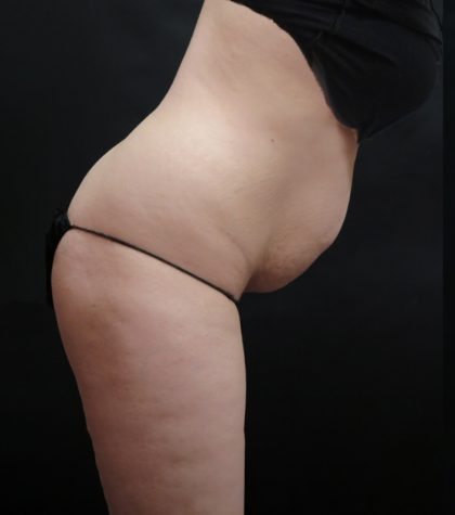Tummy Tuck Before & After Patient #3396
