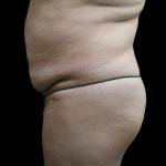 Tummy Tuck Before & After Patient #3403