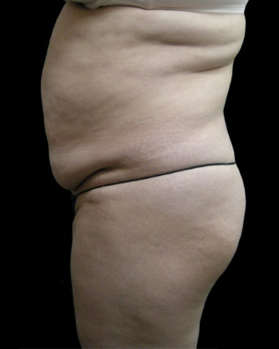 Tummy Tuck Before & After Patient #3403