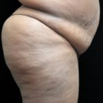 Tummy Tuck Before & After Patient #3412
