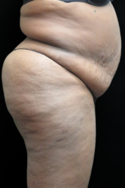 Tummy Tuck Before & After Patient #3412