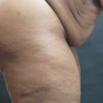 Tummy Tuck Before & After Patient #3419