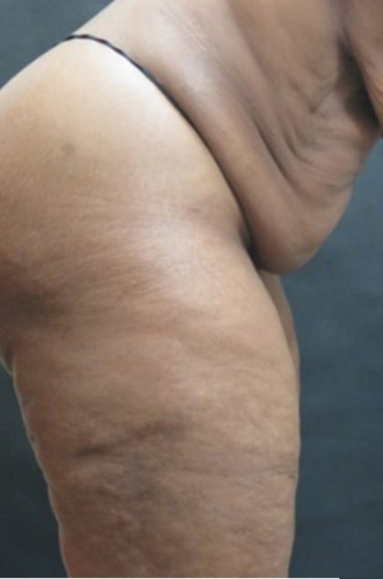 Tummy Tuck Before & After Patient #3419