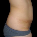Tummy Tuck Before & After Patient #3426