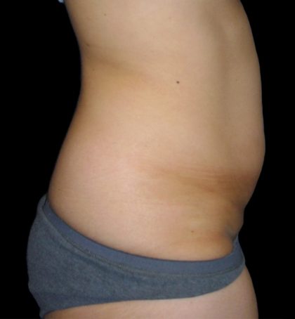 Tummy Tuck Before & After Patient #3426