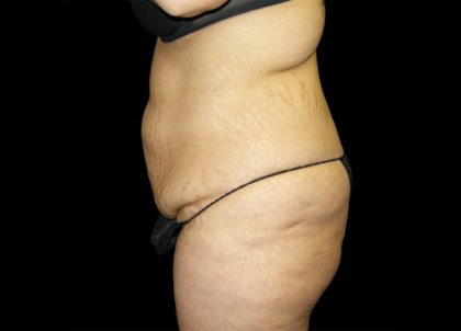 Tummy Tuck Before & After Patient #3433