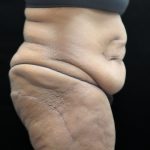 Tummy Tuck Before & After Patient #3352