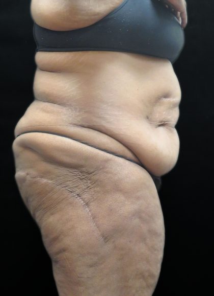 Tummy Tuck Before & After Patient #3352