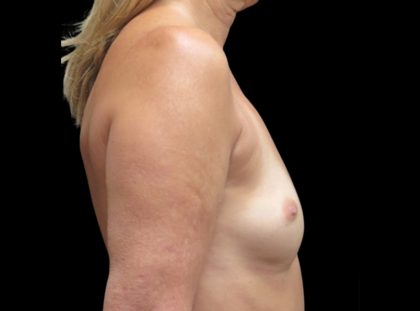 Breast Augmentation Before & After Patient #1129