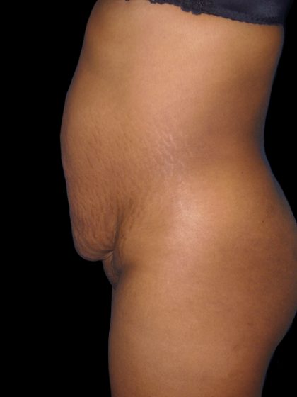 Mommy Makeover Before & After Patient #2442