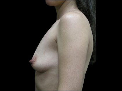 Breast Augmentation Before & After Patient #1059