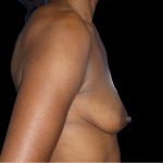 Breast Augmentation Before & After Patient #1098