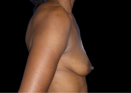 Breast Augmentation Before & After Patient #1098