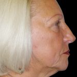 Browlift Before & After Patient #1461