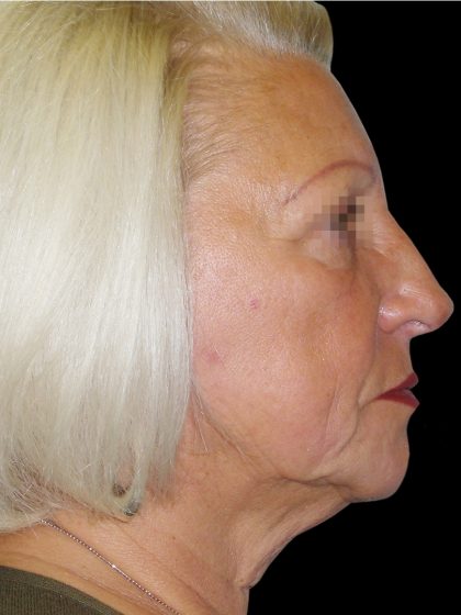Browlift Before & After Patient #1461