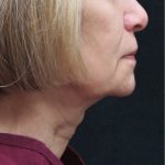 Levinelift Before & After Patient #2008