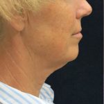 Levinelift Before & After Patient #1999