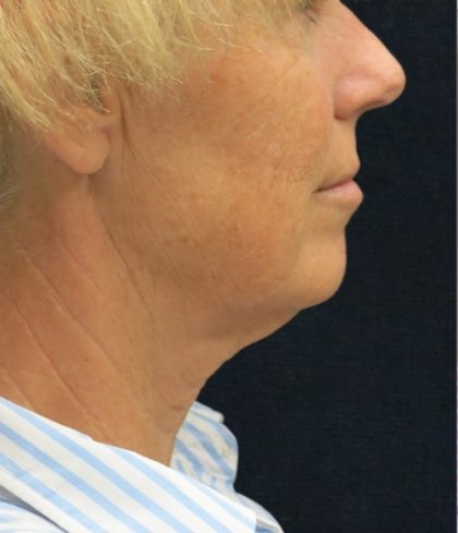 Levinelift Before & After Patient #1999