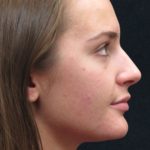 Rhinoplasty Before & After Patient #2926
