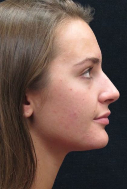 Rhinoplasty Before & After Patient #2926