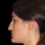 Rhinoplasty Before & After Patient #2919