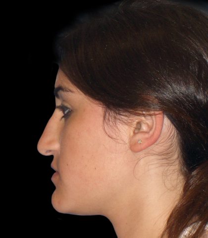 Rhinoplasty Before & After Patient #2919