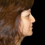 Rhinoplasty Before & After Patient #2805