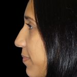 Rhinoplasty Before & After Patient #2912