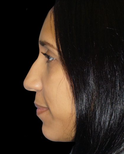 Rhinoplasty Before & After Patient #2912
