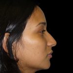 Rhinoplasty Before & After Patient #2905