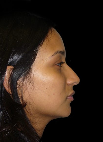 Rhinoplasty Before & After Patient #2905