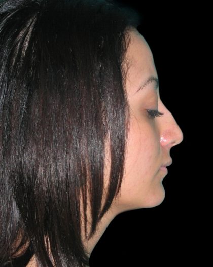 Rhinoplasty Before & After Patient #2819