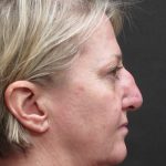 Rhinoplasty Before & After Patient #2826